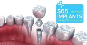 Dental-Implants-65-V2