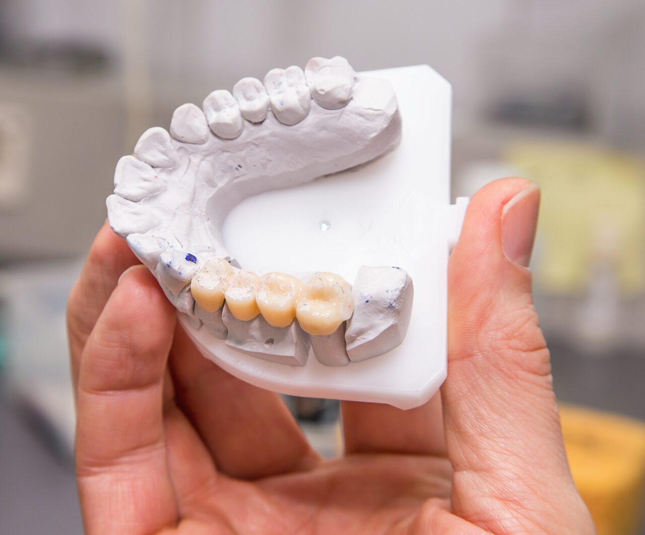 Personal-Dental-Dental-Bridges-e1529348630826