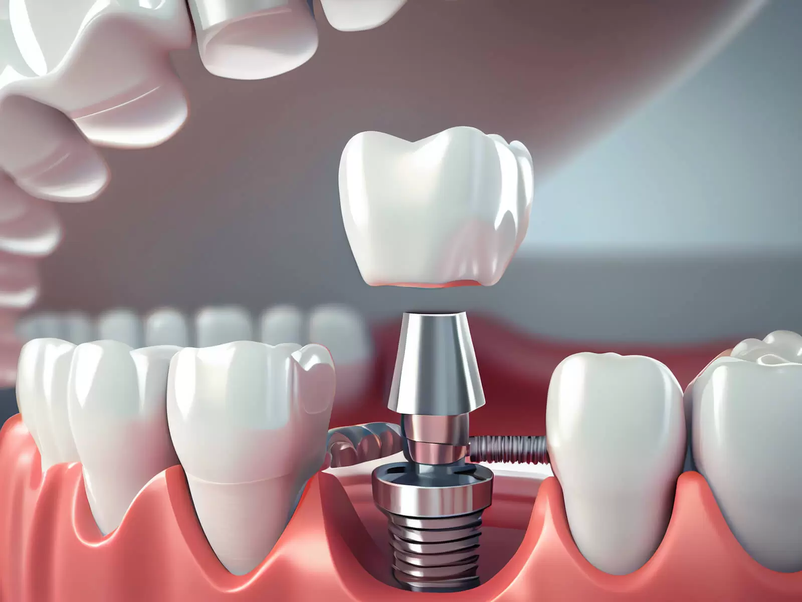 Types-Of-Crowns-For-Root-Canal-Treated-Teeth