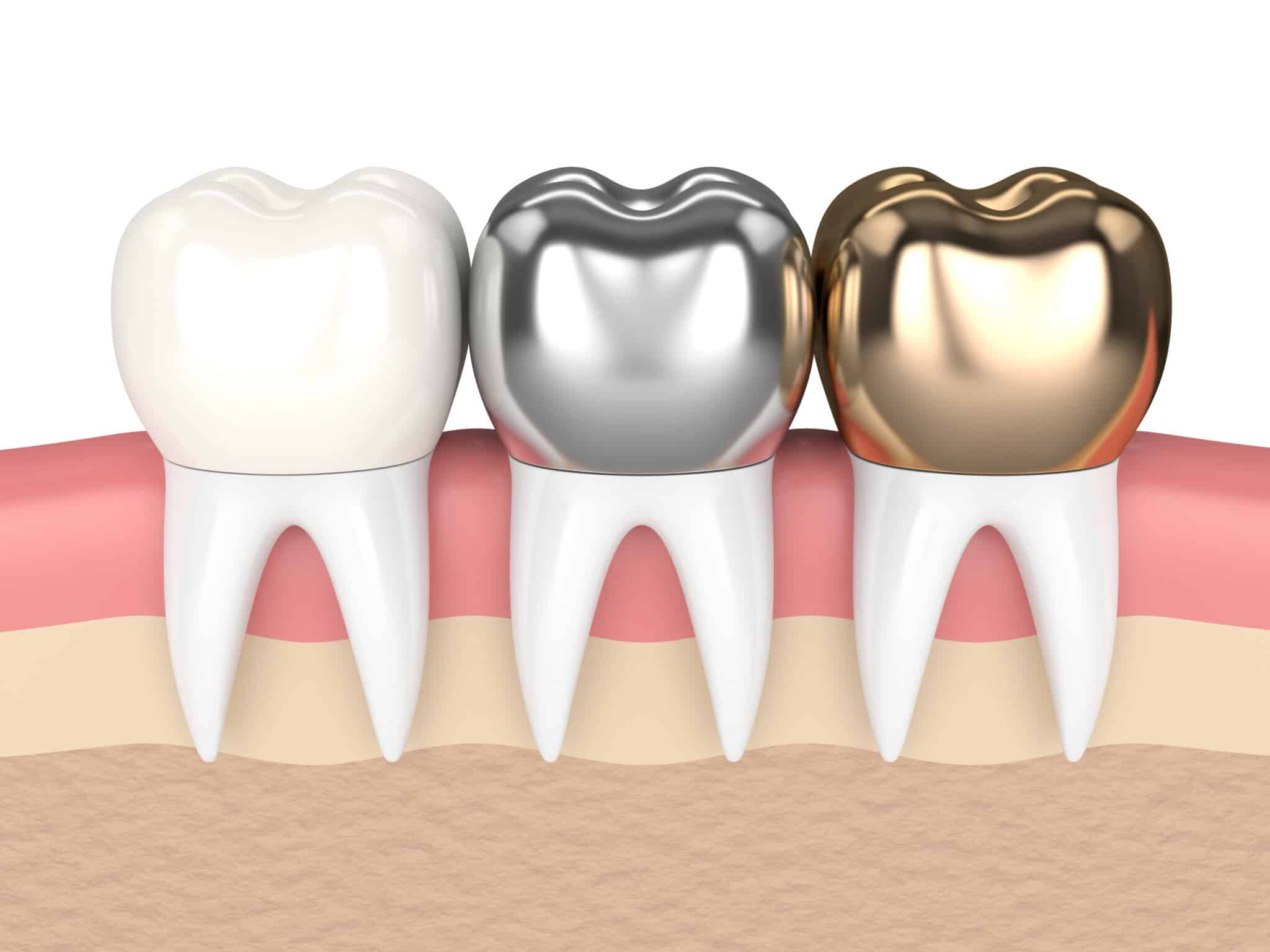 types-of-dental-crowns-scaled-1